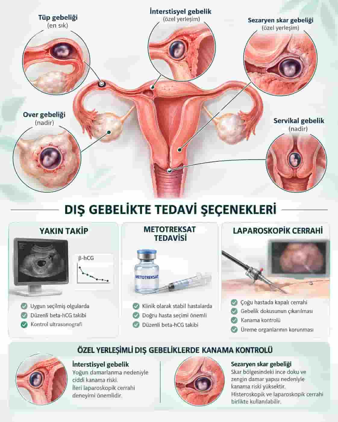 Dış Gebelik Tedavisi