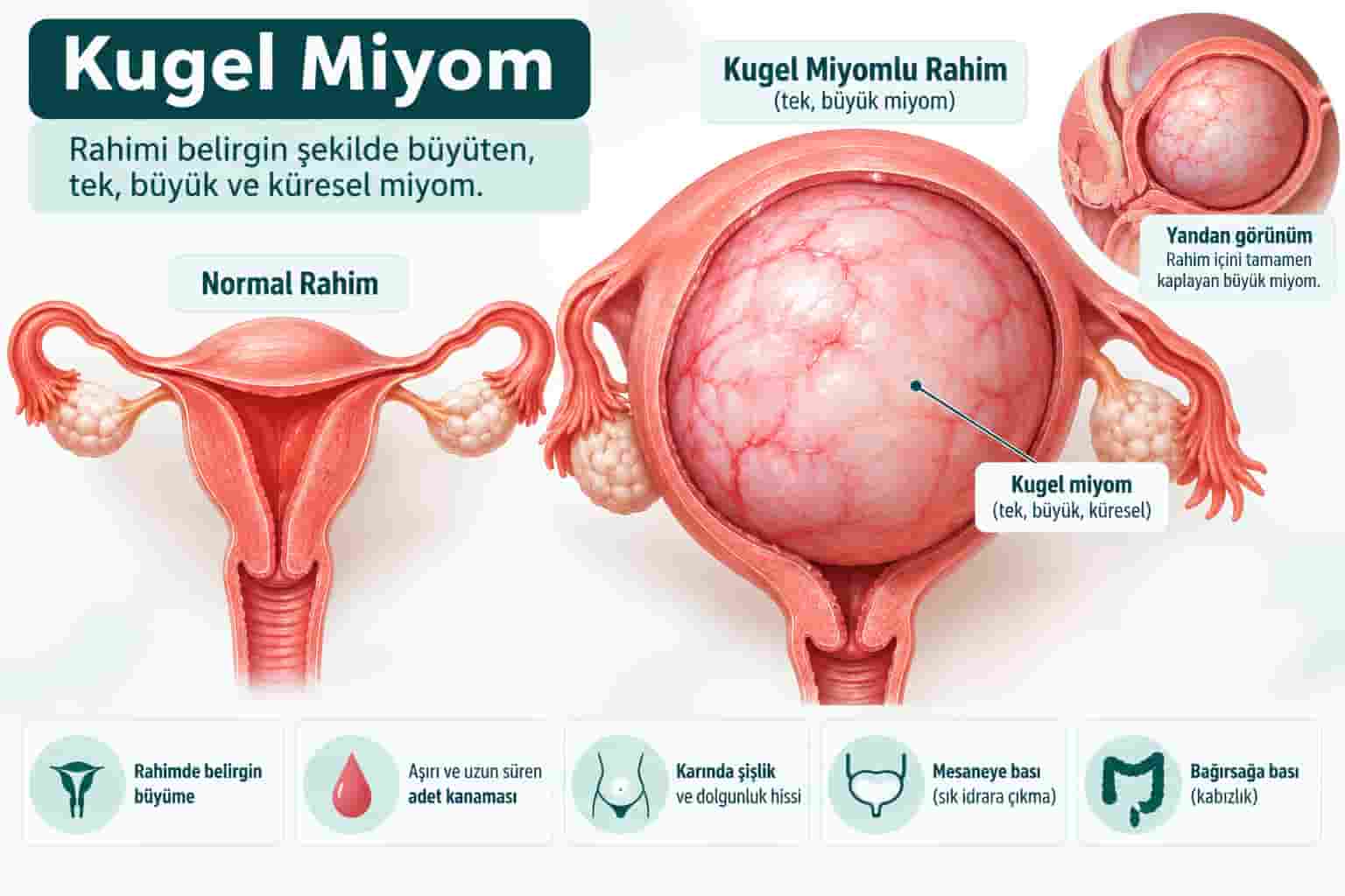Miyom Belirtileri ve Tanısı: Miyom Nasıl Anlaşılır?