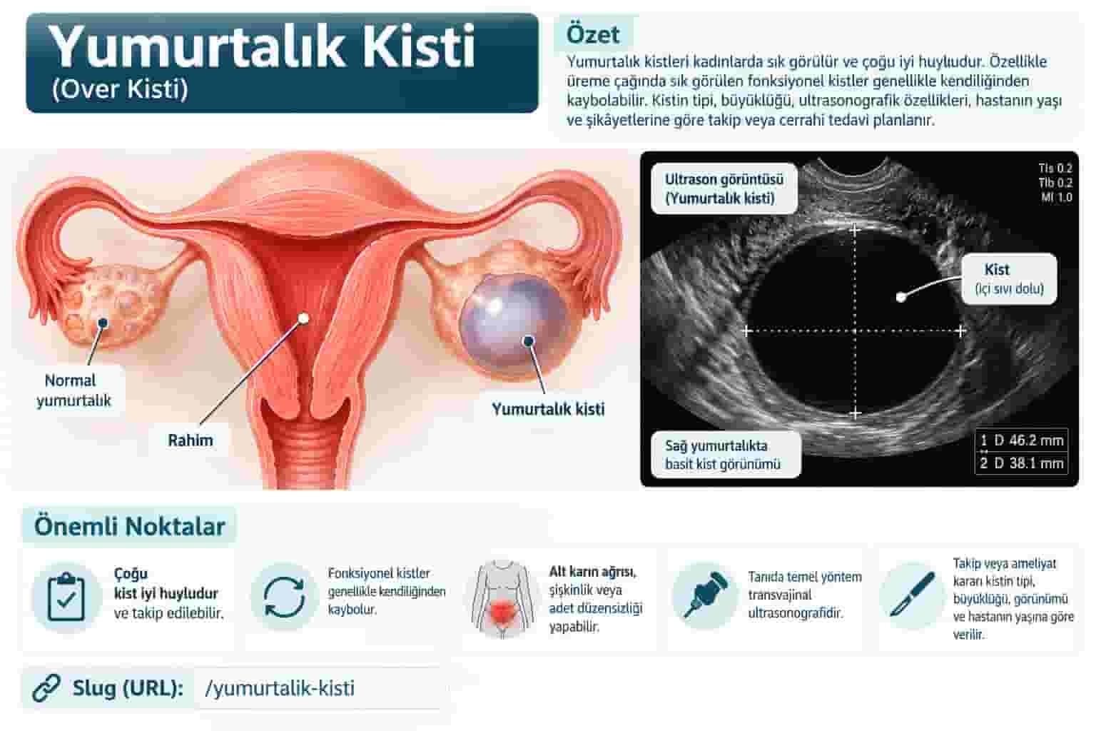 Yumurtalık Kistleri: Belirtileri, Tanısı ve Ne Zaman Ameliyat Gerekir?