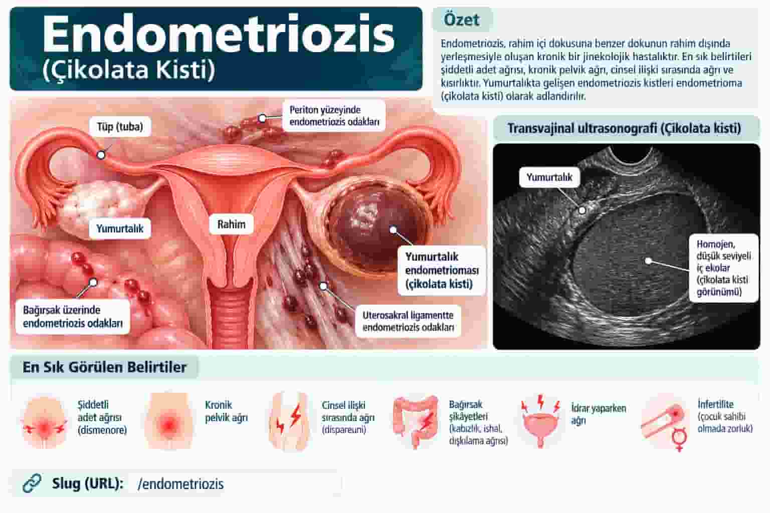 Endometriozis Nedir? Belirtileri, Endometrioma ve Tanısı